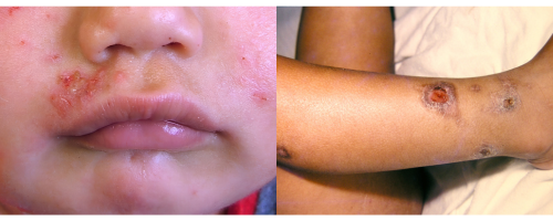 Two images of people with impetigo infection. Left image is impetigo around mouth on child with white skin; right image is impetigo on leg of child with black skin.